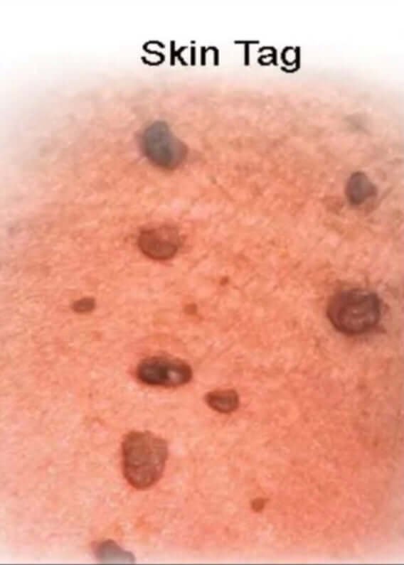 NOUVEAU‼️🍁 HUILE DE LUXE POUR L'ÉLIMINATION DES ACROCHORDONS (SKIN TAGS) DE PEAU AU EXTRAITS DE « Thuja occidentalis »🍃. – Image 4