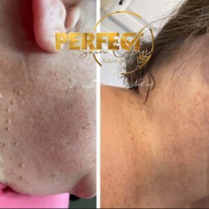 NOUVEAU‼️🍁 HUILE DE LUXE POUR L'ÉLIMINATION DES ACROCHORDONS (SKIN TAGS) DE PEAU AU EXTRAITS DE « Thuja occidentalis »🍃.