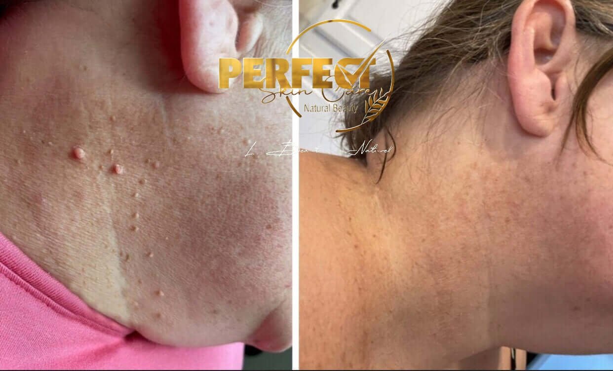 NOUVEAU‼️🍁 HUILE DE LUXE POUR L'ÉLIMINATION DES ACROCHORDONS (SKIN TAGS) DE PEAU AU EXTRAITS DE « Thuja occidentalis »🍃.