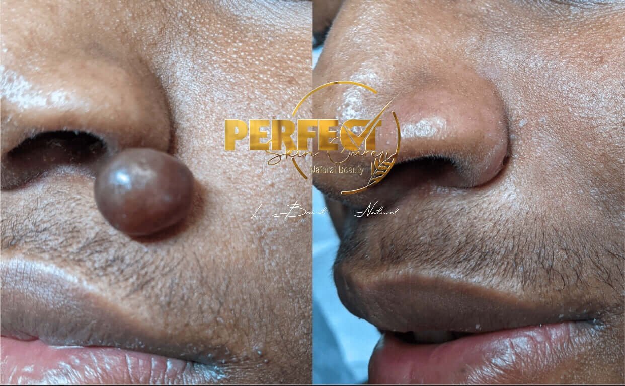 NOUVEAU‼️🍁 HUILE DE LUXE POUR L'ÉLIMINATION DES ACROCHORDONS (SKIN TAGS) DE PEAU AU EXTRAITS DE « Thuja occidentalis »🍃. – Image 5